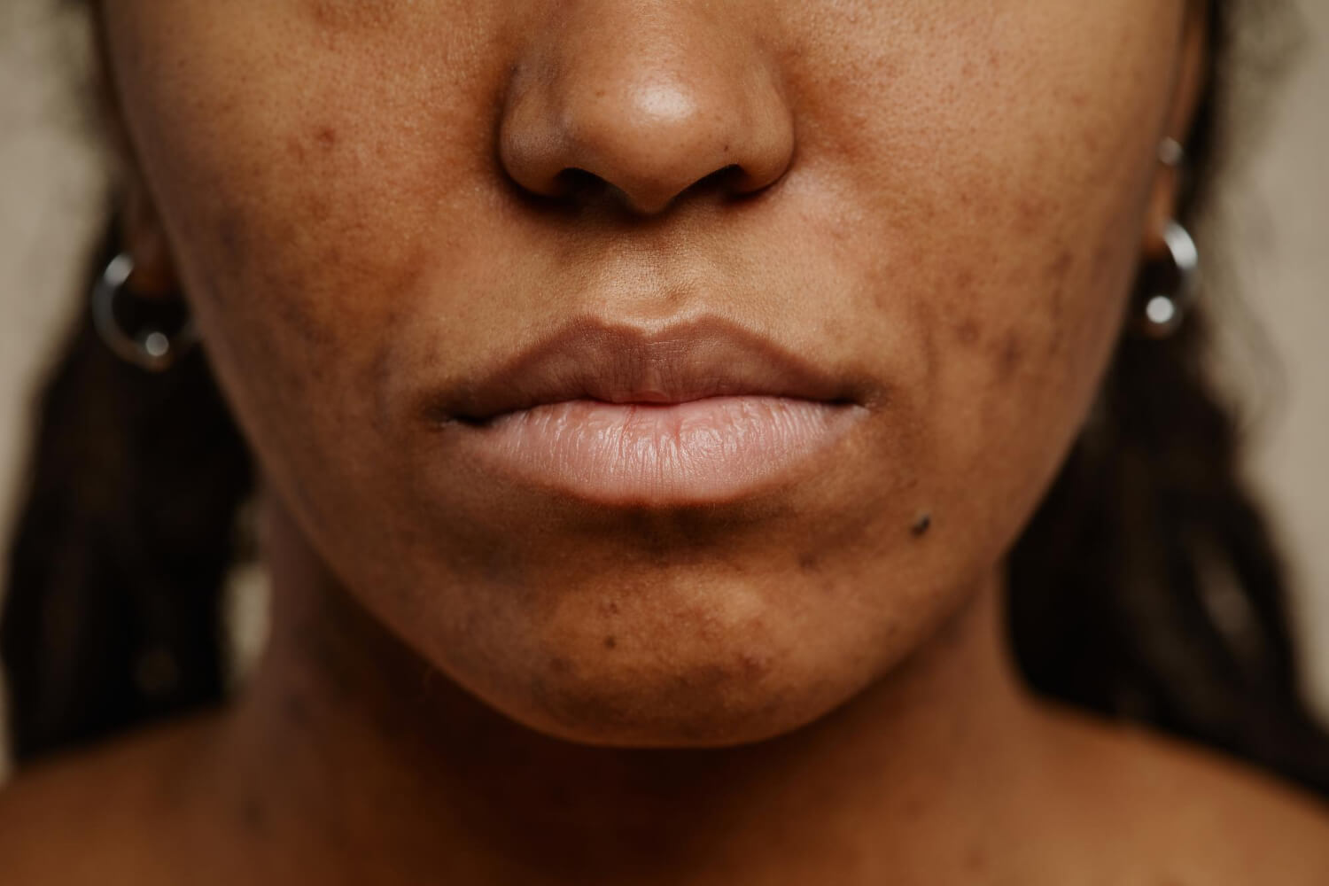 Close-up view of the lower half of a person's face showing skin hyperpigmentation, dark spots, and acne scarring around the cheeks, chin, and upper lip.